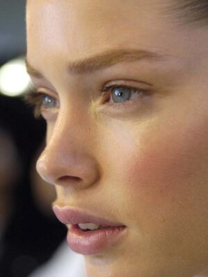 rinoplastia sin cirugía