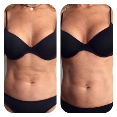 Radiofrecuencia abdomen antes y después