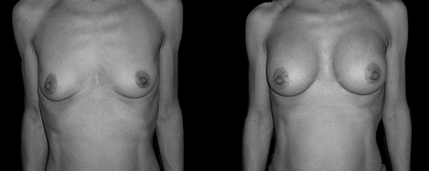 Aumento de mamas. Prótesis anatómica: 220 grs.