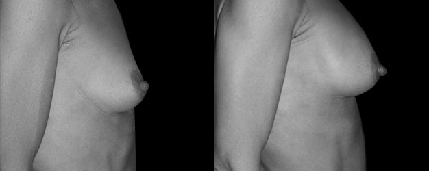 aumento de mamas. Incisión: surco submamario.