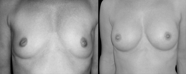 Aumento de pecho. Implantes anatómicos: 195 grs.