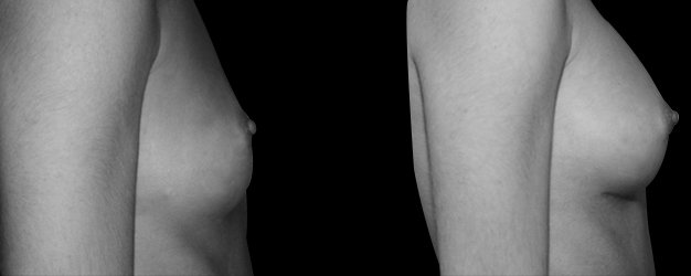 Aumento de pecho antes y después. Vía submamamaria.