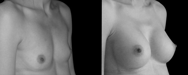 Aumento de pecho natural. Plano debajo del músculo.