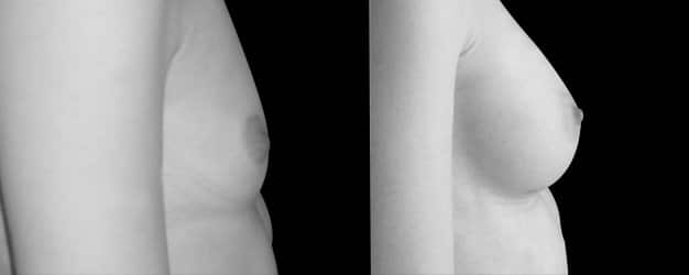 Aumento de pecho natural. Cicatriz surco submamario.