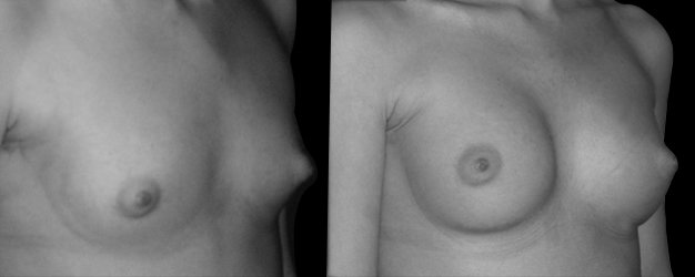 Aumento de senos. Plano submuscular.