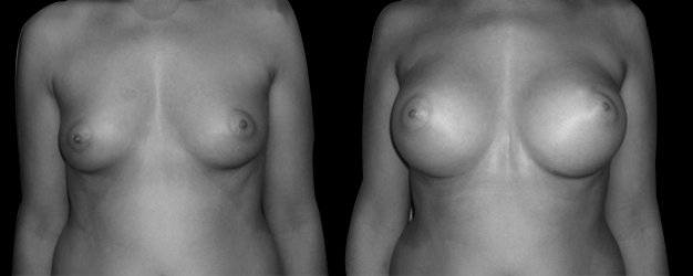 Mamoplastia de aumento. Prótesis redondas: 295-275 grs.