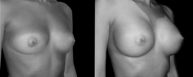 Operación aumento de pecho. Plano submuscular.