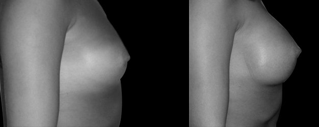 Operación aumento de pecho. Técnica Inframamaria.