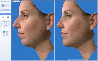 Rinoplastia antes y después.