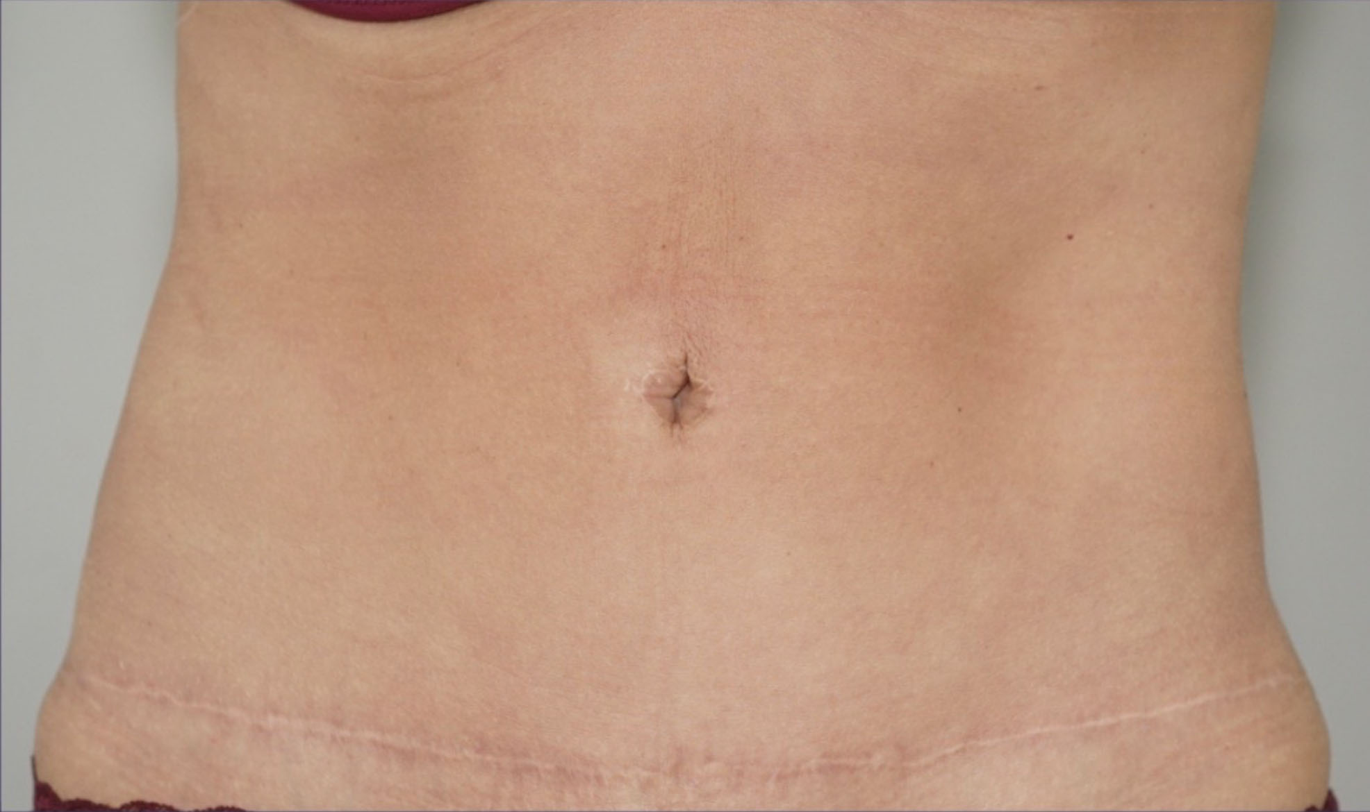 Abdominoplastia antes y después.