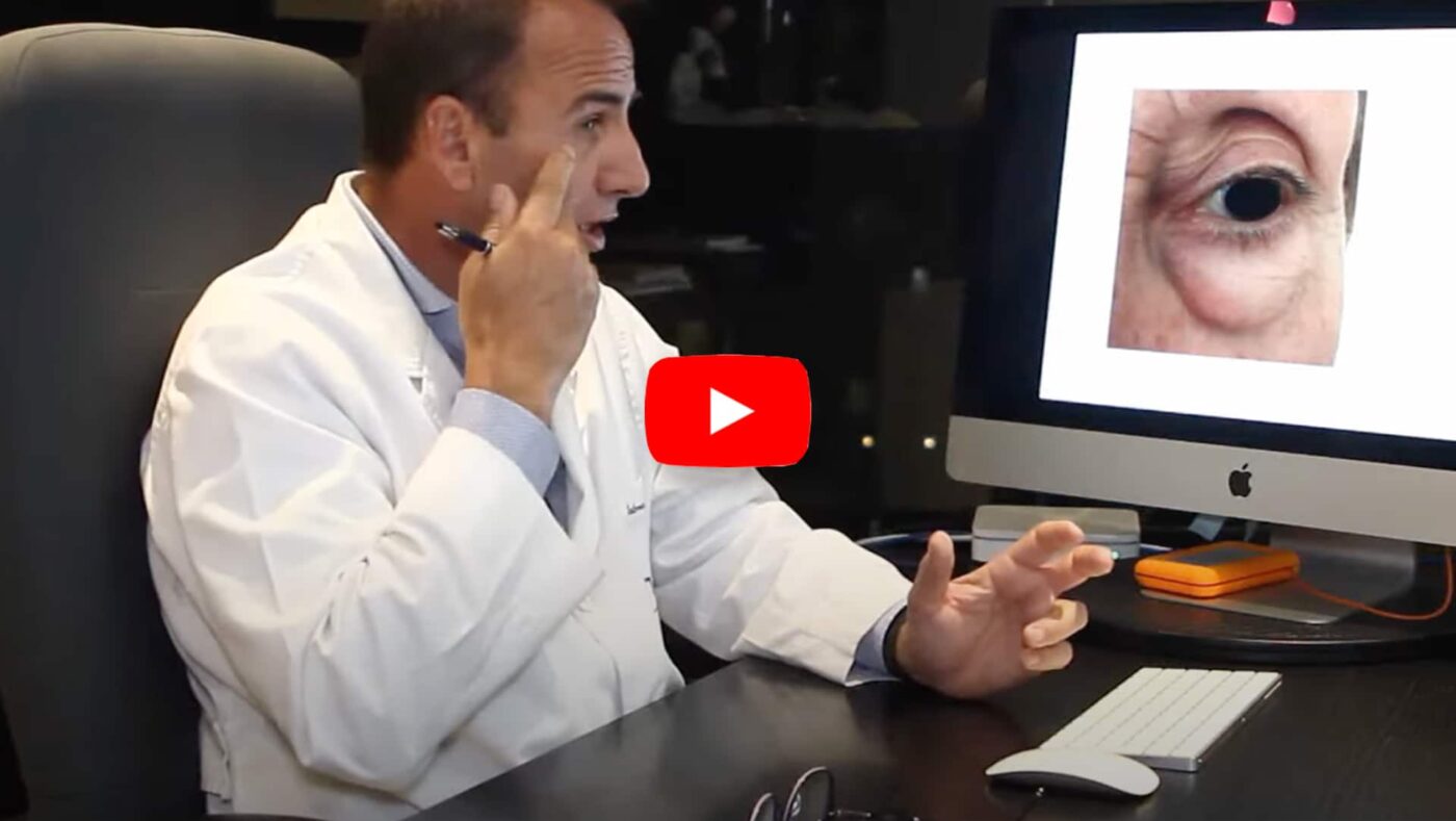 Vídeo blefaroplastia párpado inferior Dr. Paloma