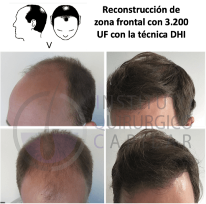 Técnica FUE antes y después