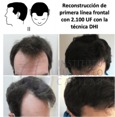 Técnica FUE primera-linea-frontal-antes y después