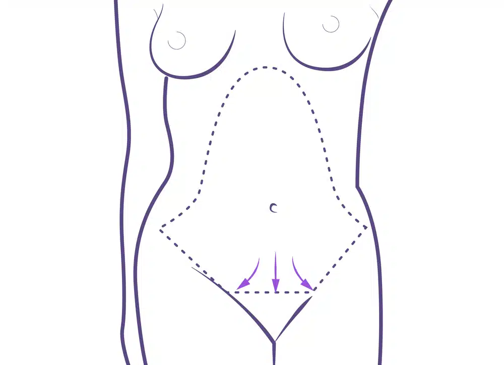 Abdominoplastia cicatriz.