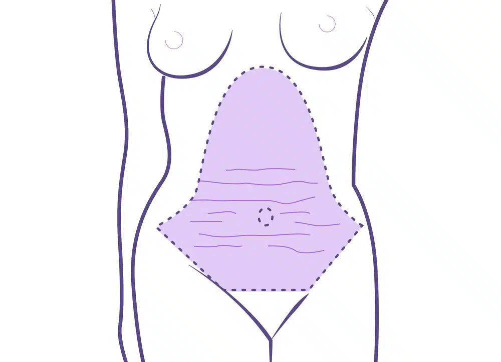 Abdominoplastia operación.