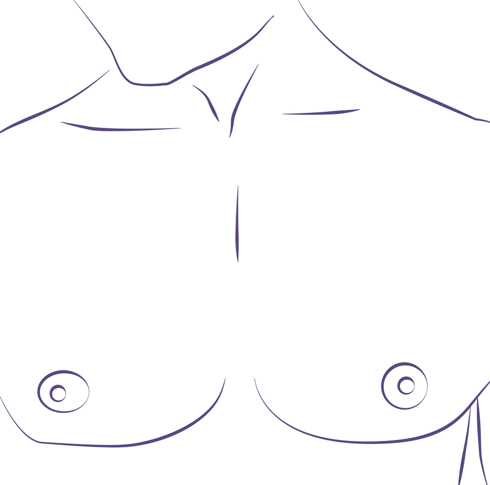 Senos antes de una cirugía de ginecomastia