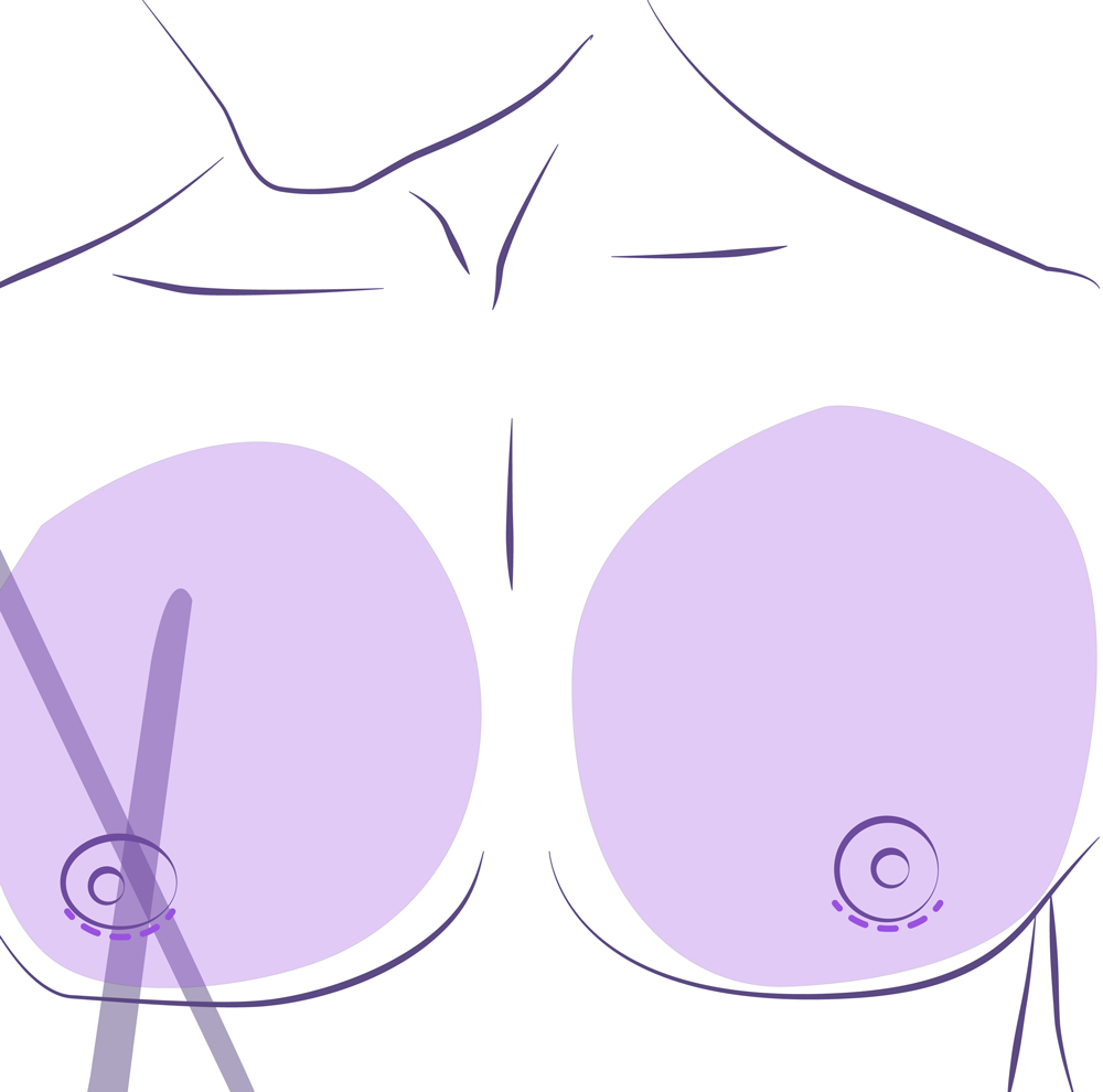 Cicatriz inapreciable en la reducción de pecho en hombres