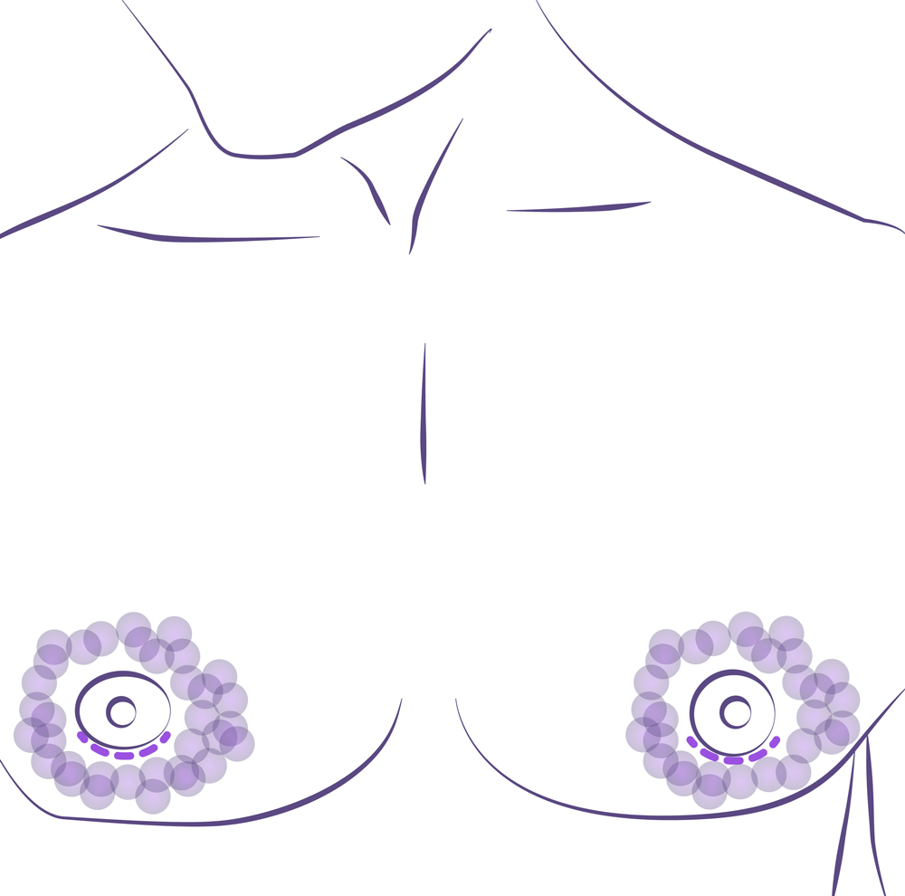 Pequeña incisión en el borde de la areola en la operacion ginecomastia