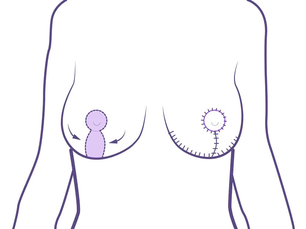 Areola en su nueva posición tras la reducción de pecho