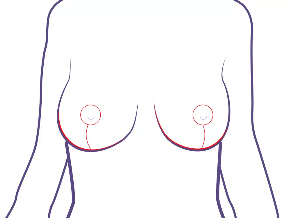Resultado final y cicatrices tras reducción de pecho
