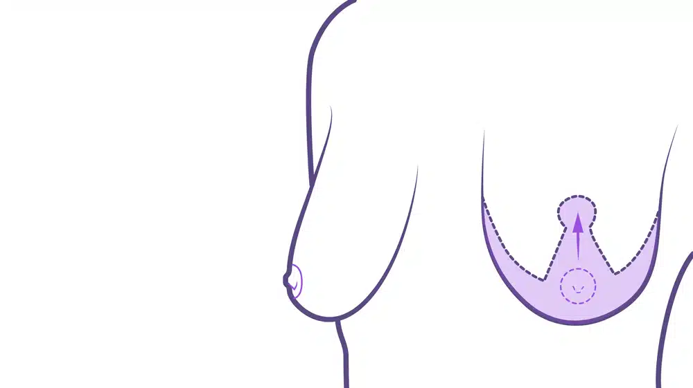 Diseño para elevar el pecho