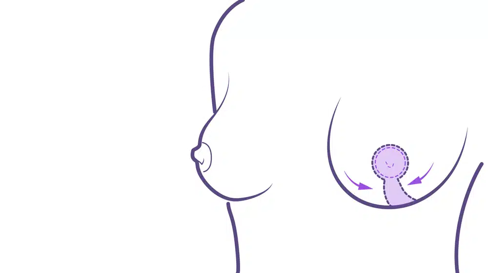 Areola en nueva posición en elevación pecho