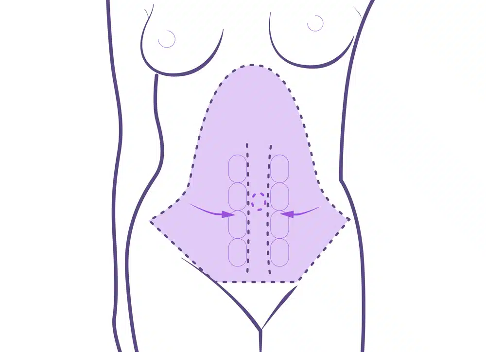 Operación tummy tuck.