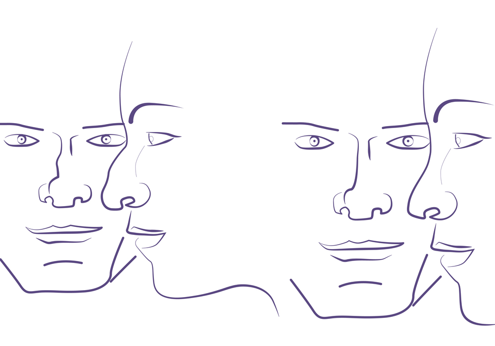 Rinoplastia antes y después.