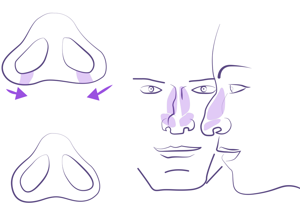 Rinoplastia nariz ancha.