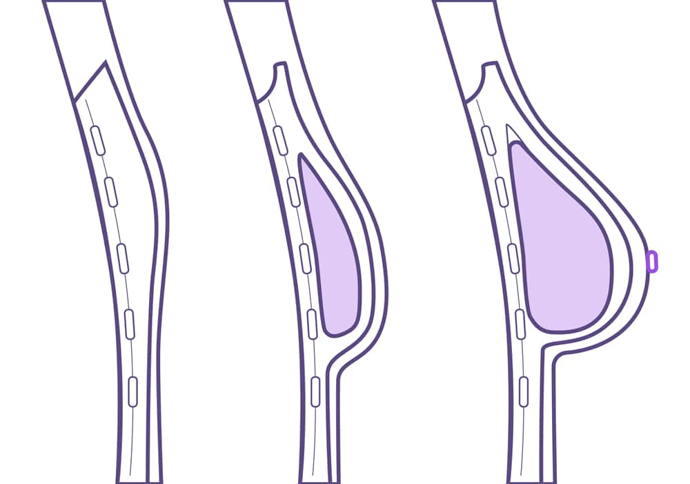 Expansión mama para reconstruir pecho