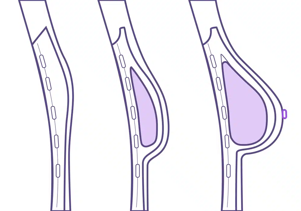 Expansión mama para reconstruir pecho