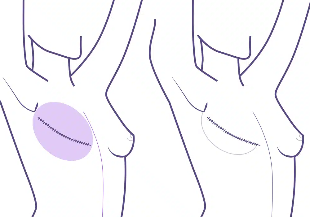 Reconstrucción seno mediante expansión y prótesis