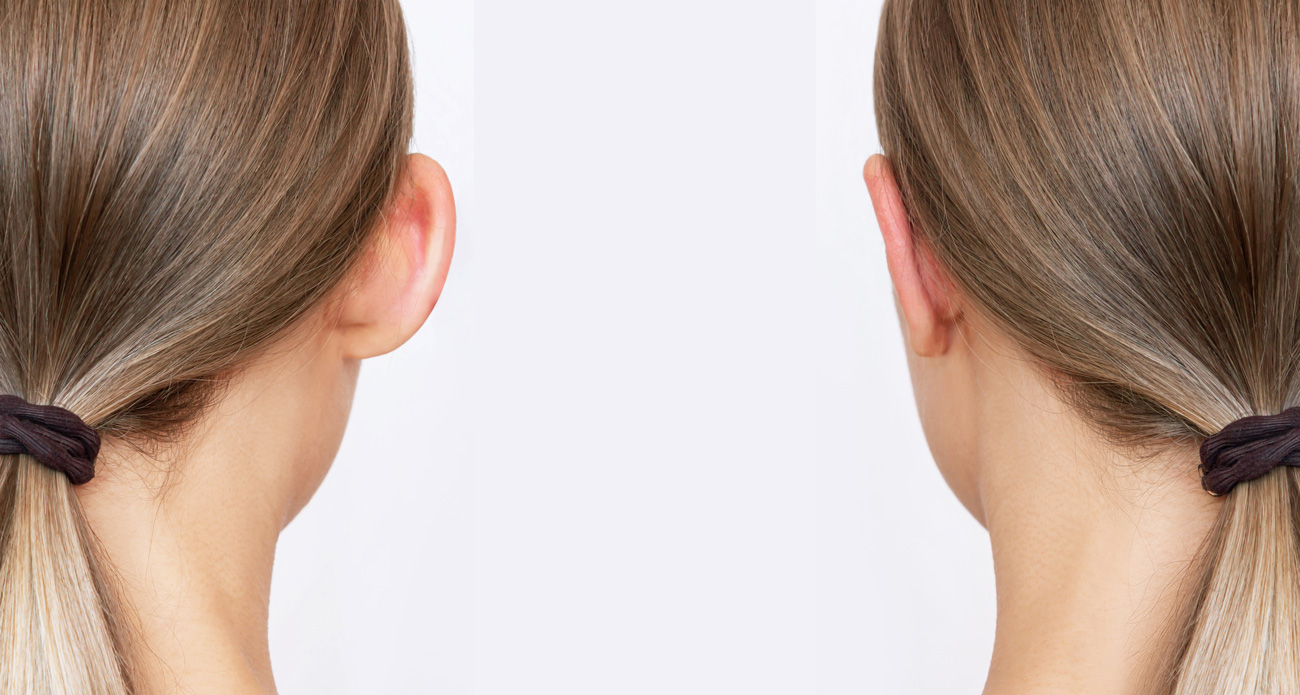 Operación orejas de soplillo Barcelona.