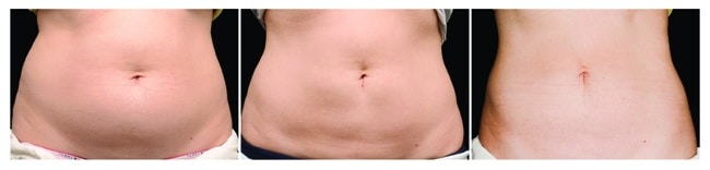 CoolSculpting antes y después - barriga mujer