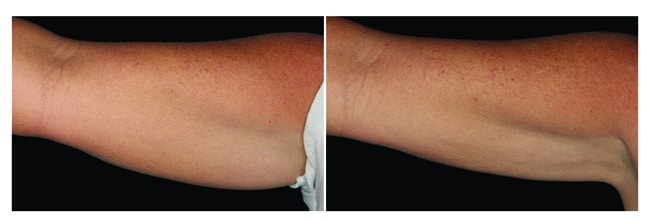 CoolSculpting antes y después - brazos hombre