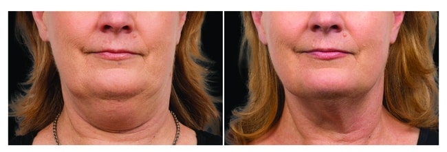 CoolSculpting papada antes y después - mujer