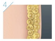 CoolSculpting resultado: visible al mes