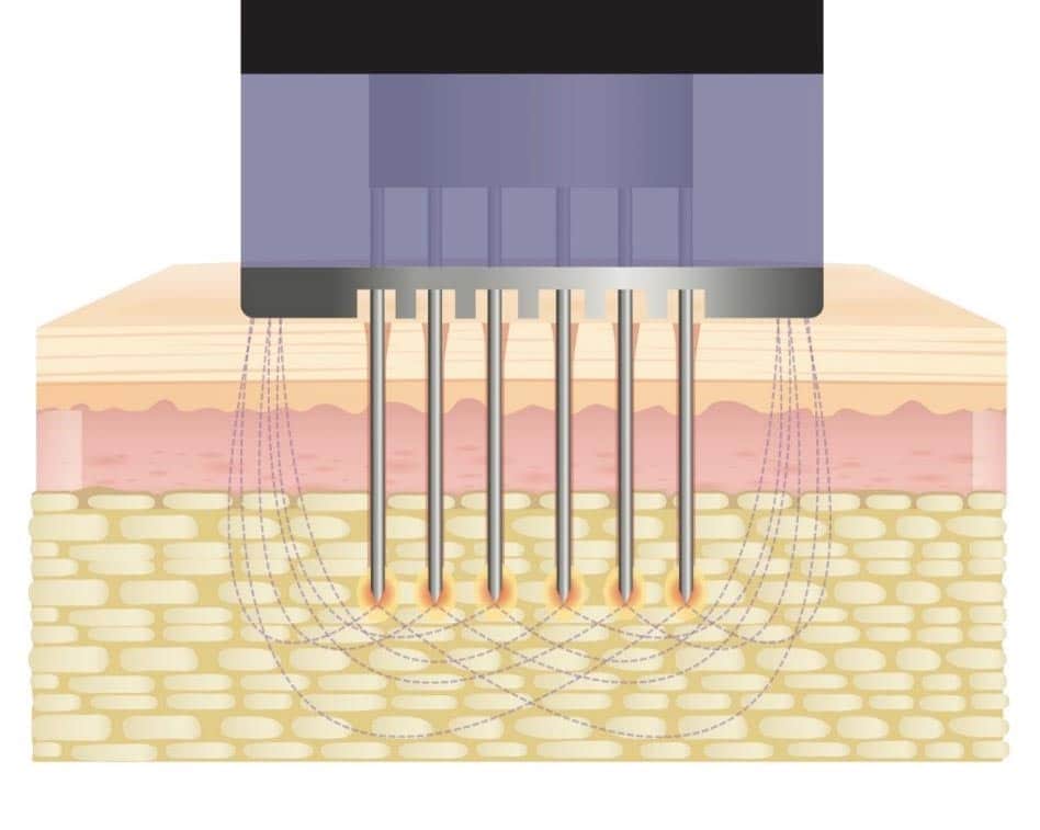 Lifting sin cirugía
