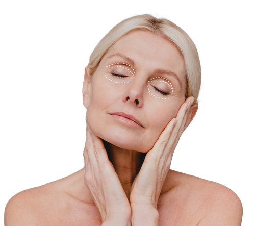 Blefaroplastia parpado superior