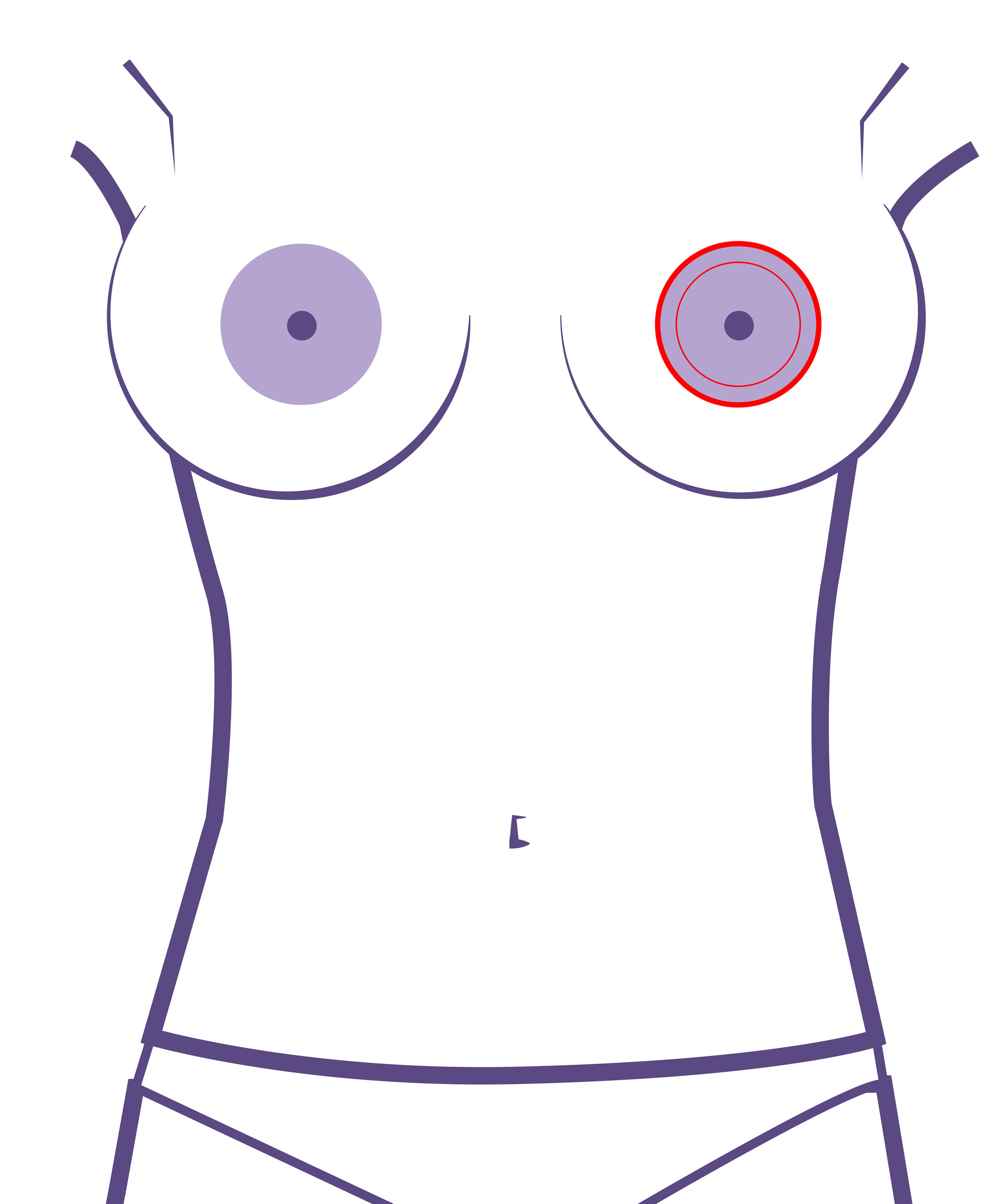 operación para reducir el tamaño de los pezones