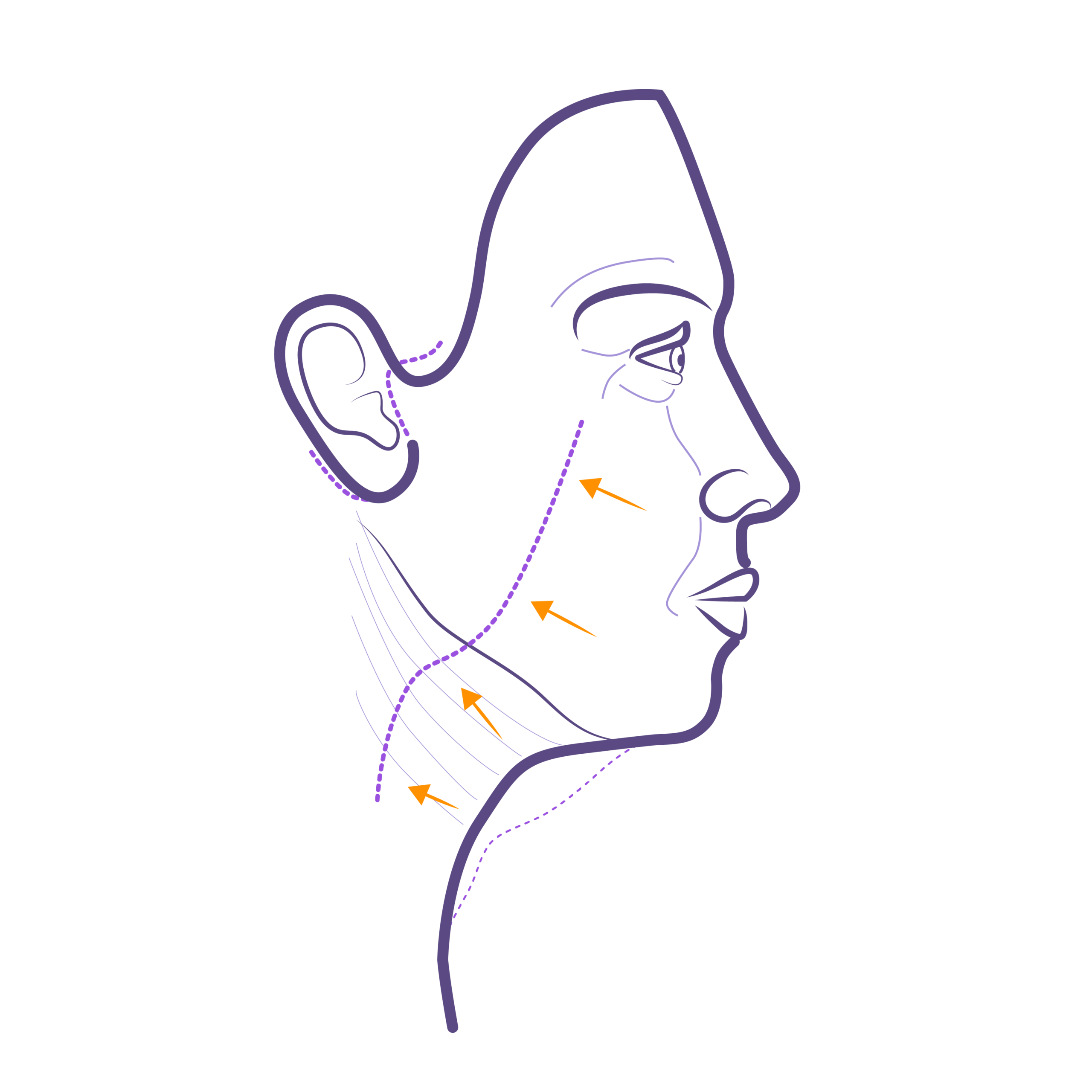 Lifting facial cirugía