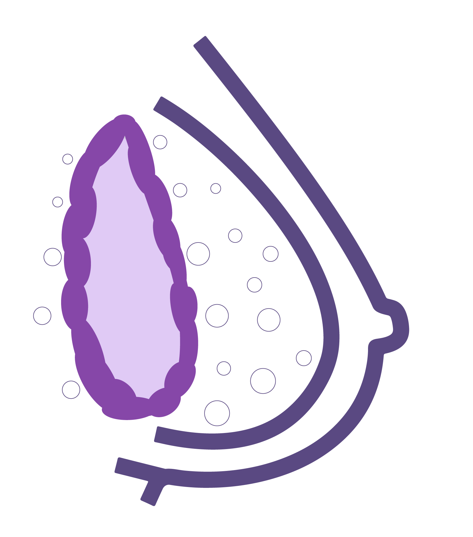 contractura capsular o prótesis mama