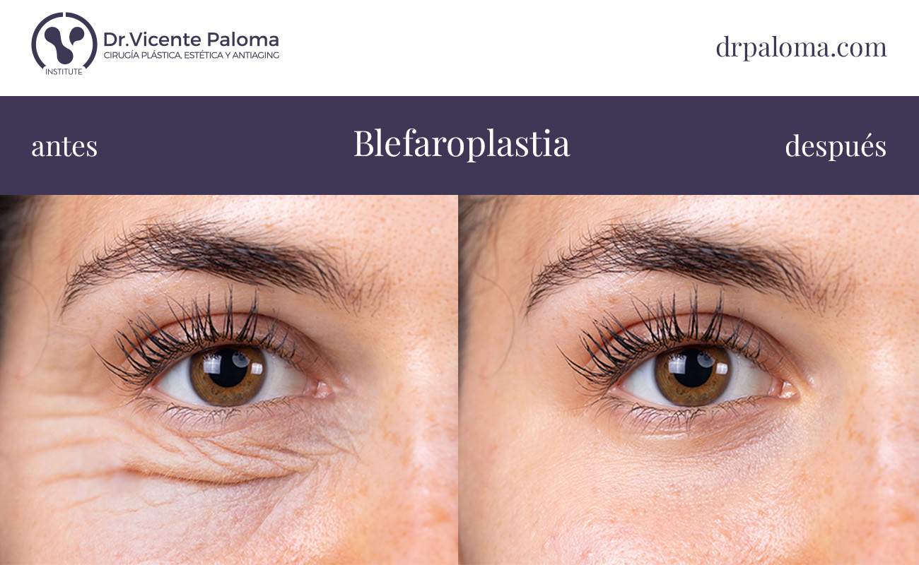 blefaroplastia inferior antes y después