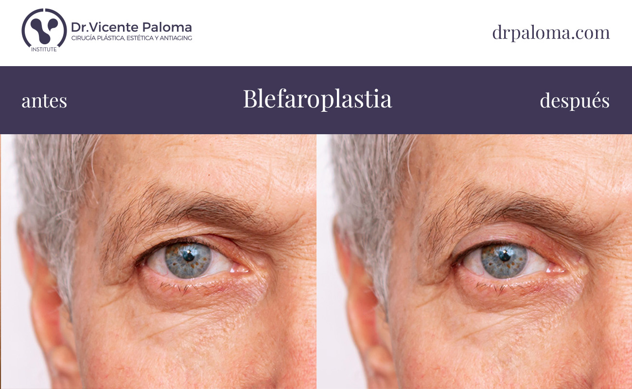 blefaroplastia superior antes y después