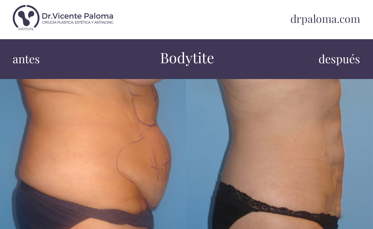 bodytite abdomen antes y después