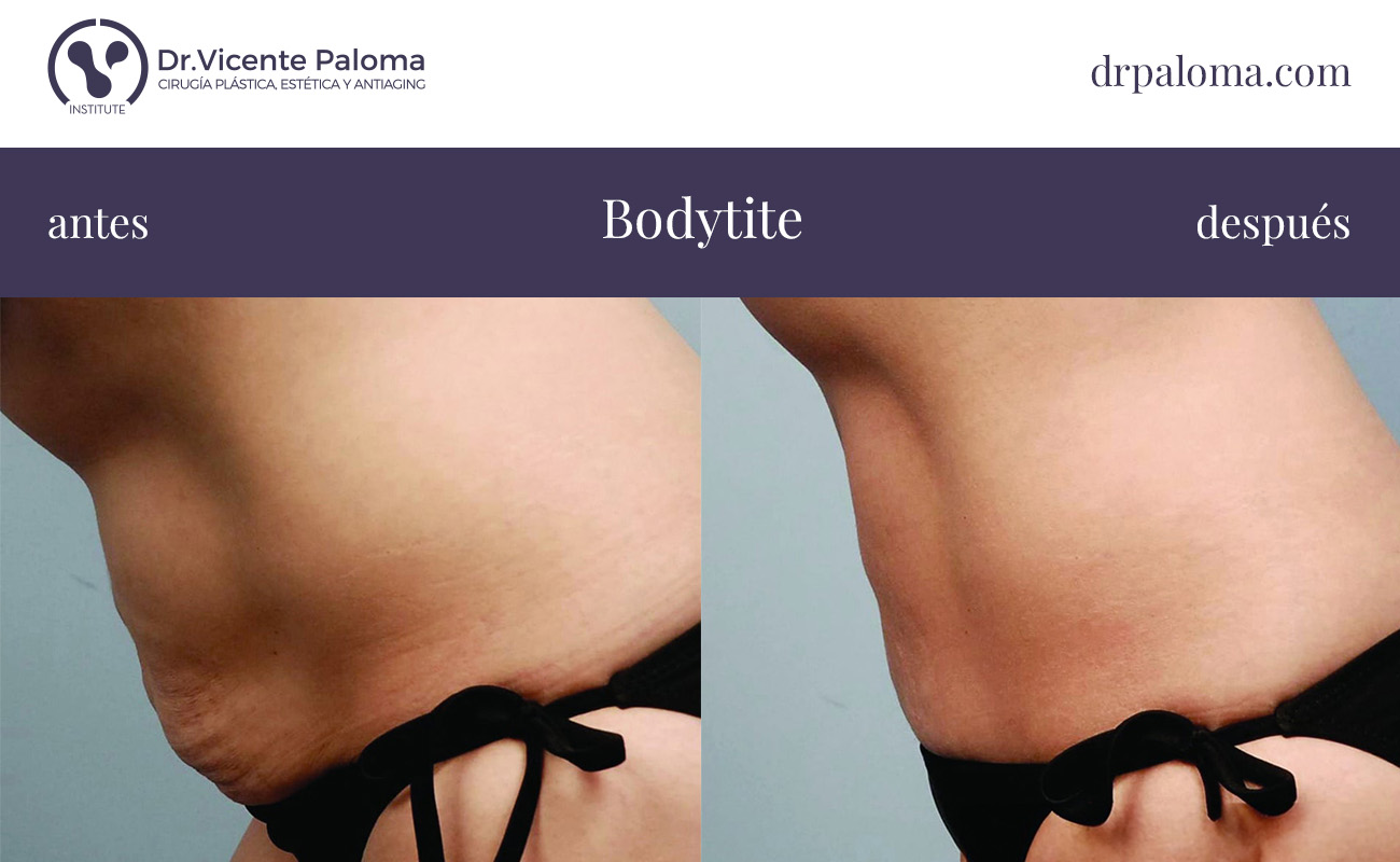 bodytite antes y después