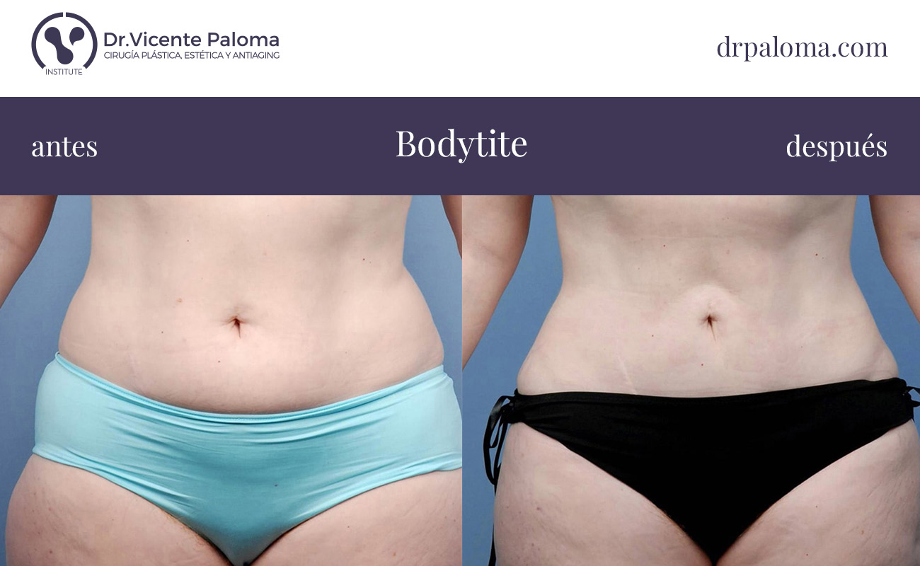 bodytite brazos y abdomen antes y después