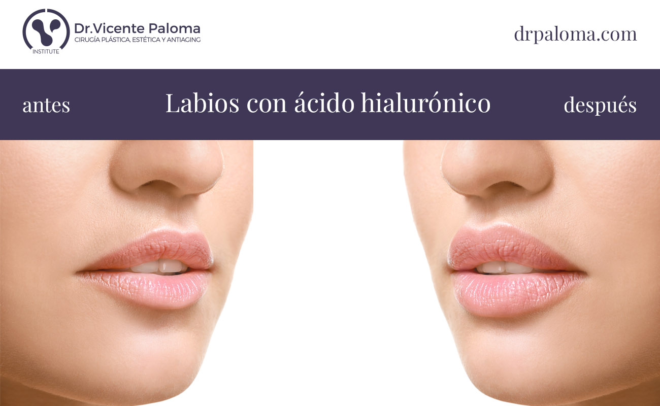 acido hialuronico labios antes y despues