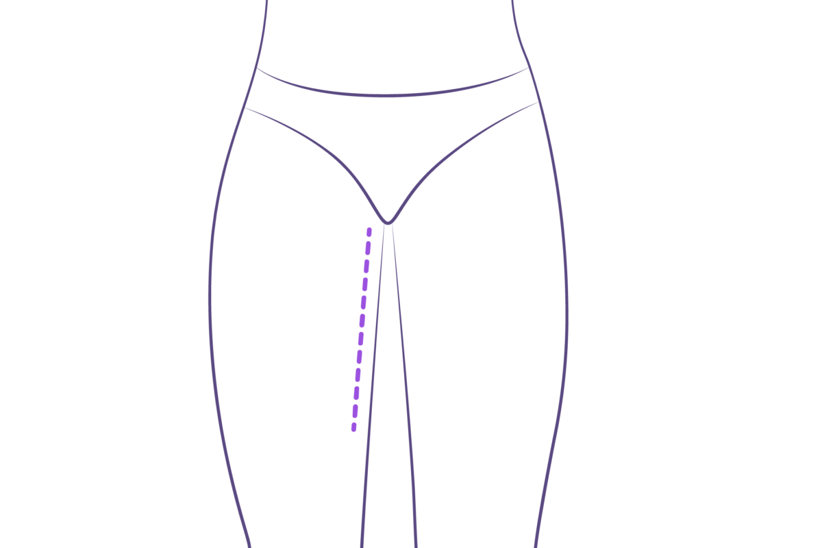 dermolipectomia muslos cara anterior de los muslos