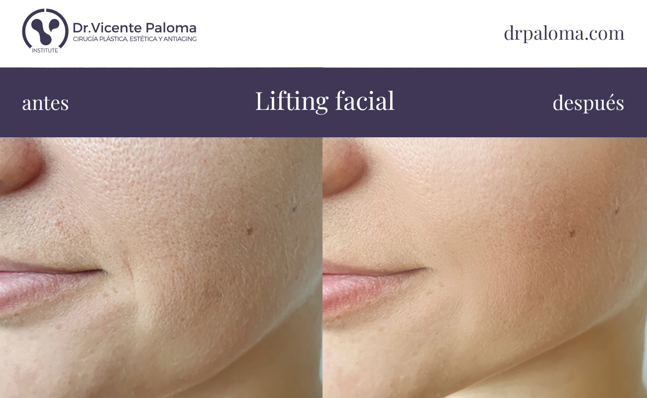 cirugía de estiramiento facial antes y después